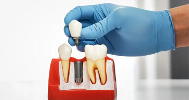 中国限制种植牙治疗费用