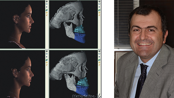 L’avvento della tecnologia tridimensionale nella Chirurgia Maxillo-Facciale: intervista ad Alberto Bianchi