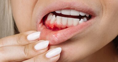 Parodontitis: Mundgesundheit von rund 35 Millionen betroffen