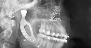 Implantan la primera articulación mandibular impresa en 3-D en Australia