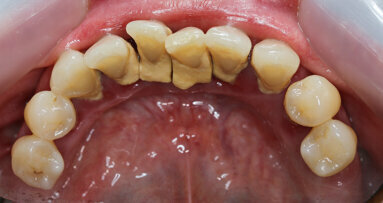 Periodontal disease increases risk of chronic diseases, including mental ill health