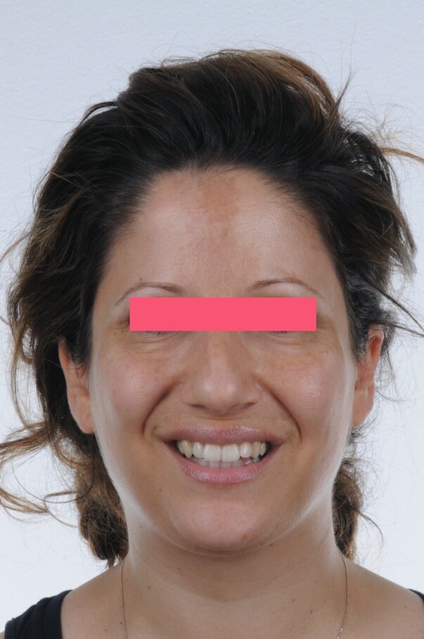 Figg. 1a-1c - Foto extraorali pre-trattamento: visioni frontale, frontale del sorriso e laterale.