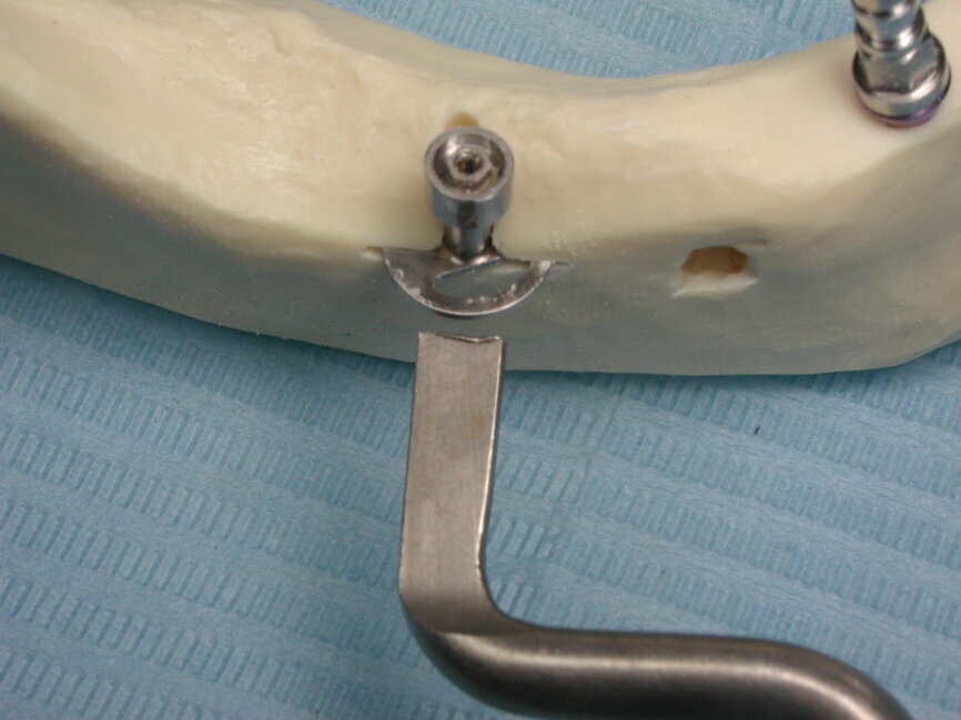 Fig. 8a : L’ostéotomie préalable à l’insertion de l’implant se réalise le plus souvent latéralement (Photo : EPSON)