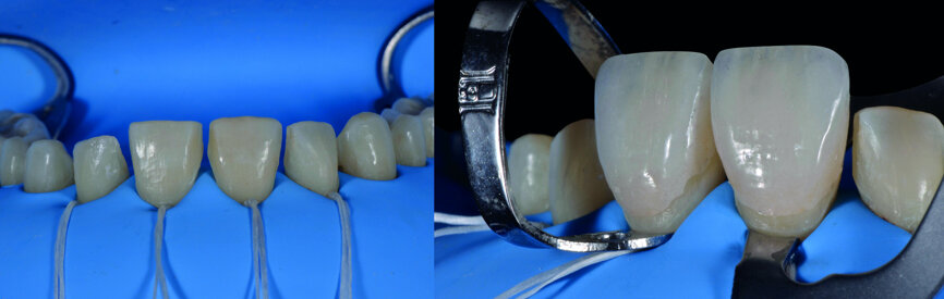 Fig. 16a: Isolation fi eld and try-in of the fi t of the veneers on teeth #11 and 21.