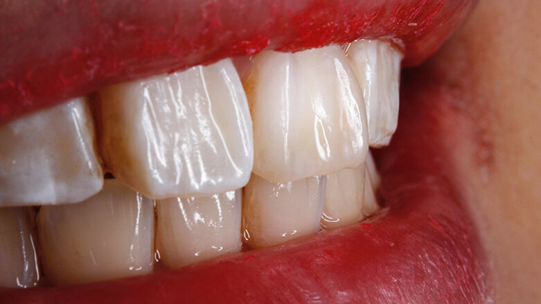 Composite artistry in everyday clinical practice… with BioSmart restoratives