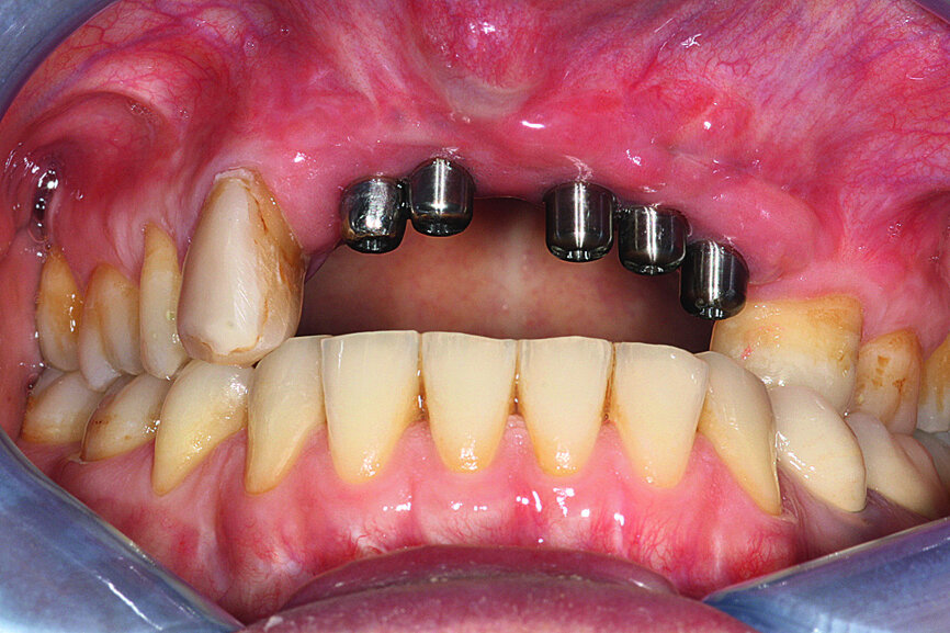 Fig. 17: Loaded implants, healing abutments in situ.