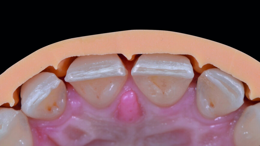 Fig. 9b: Check of the preparation depth, with the use of the silicone guide, palatal aspect.