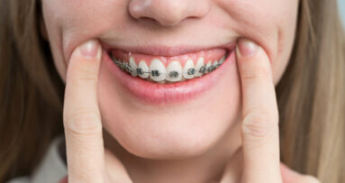 Synergie péri-ortho : « Une excellente santé parodontale est indispensable pour un résultat orthodontique escompté »