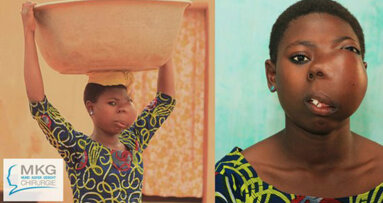 Mädchen in Togo von Gesichtstumor befreit