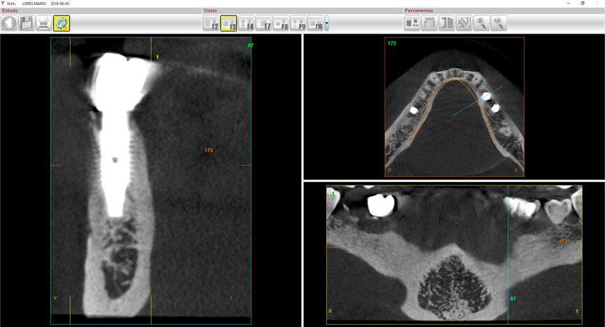 Fig. 11: The two-year follow-up post-op CBCT scan.