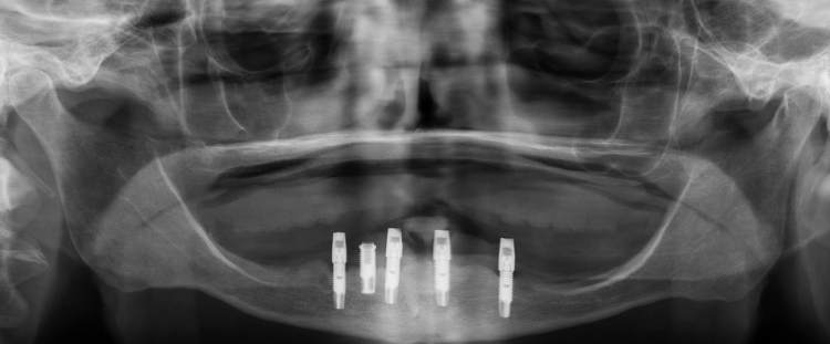 Fig. 19: Panoramic radiograph of the abutments seated on the four selected implants. Because the restoration is fully implant-supported, gradual diminution of the residual ridge will present no consequence to the patient.