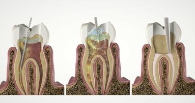 Discover SWEEPS for a more effective endodontic treatment at IDS