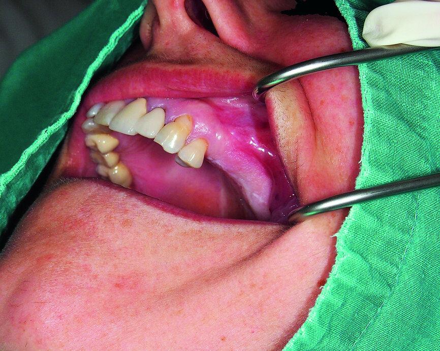 Fig. 3: Preoperative finding in a pneumatised lateral maxilla.