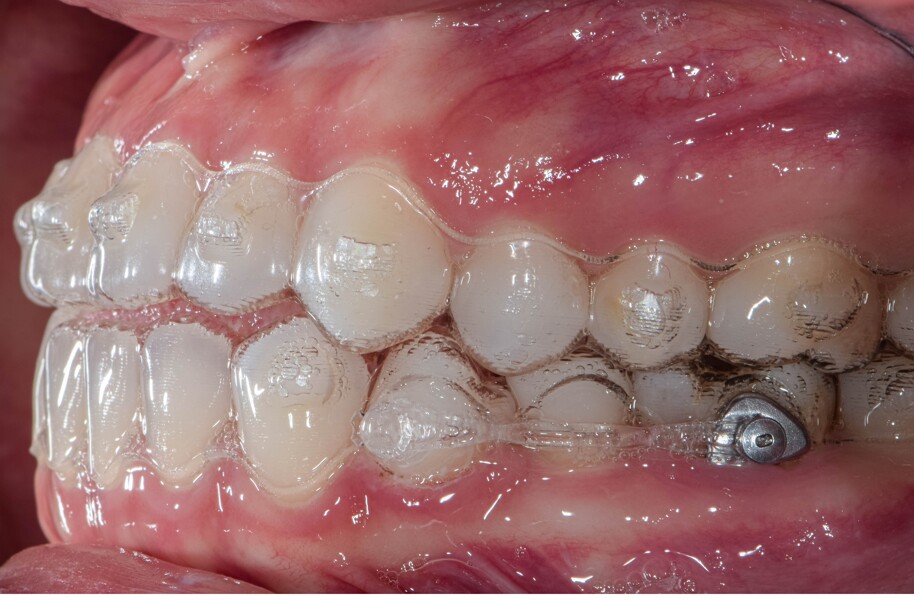 Fig. 10: Invisalign aligners with a metal Precision Aligner Button bonded to the mandibular left first molar and a clear Precision Aligner Button to the rotated premolar. A clear elastic power chain connected the two teeth and was changed every four weeks.