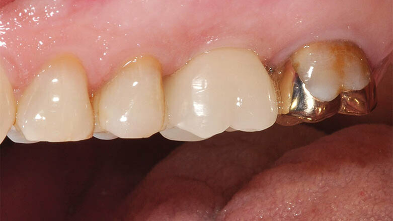 An intelligent treatment concept for the implant-supported individual tooth crown