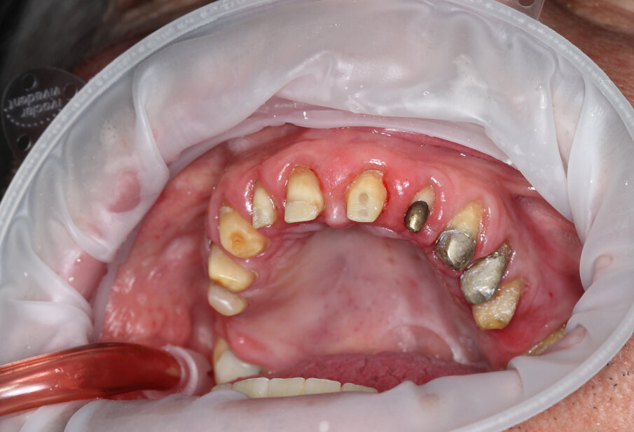 Fig. 25: Conditioning the tooth preparations