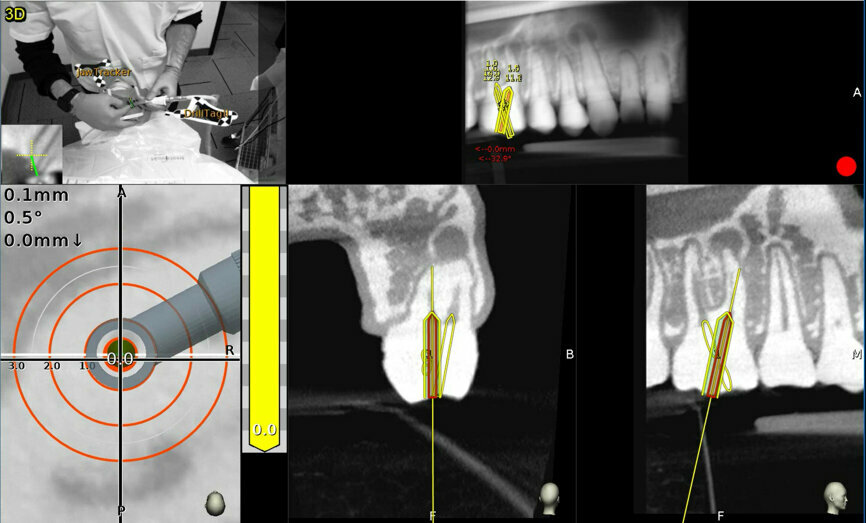 Fig. 9b: Maxillary molar: the planned canal location is on target (yellow: 0 mm). (Courtesy of Dr Bobby Nadeau)