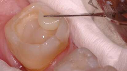 Primena različitih tipova kompozitnih materijala u direktnoj privremenoj restauraciji zuba - prikaz slučaja
