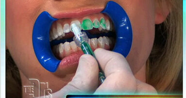 New dental treatment is featured on TV program
