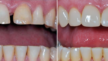 Фабрични фасети за фронтални зъби