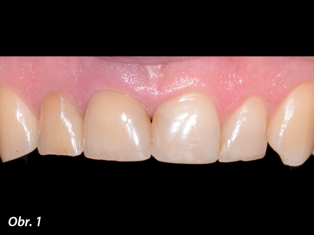 Počáteční stav – zub 11 indikovaný k extrakci.