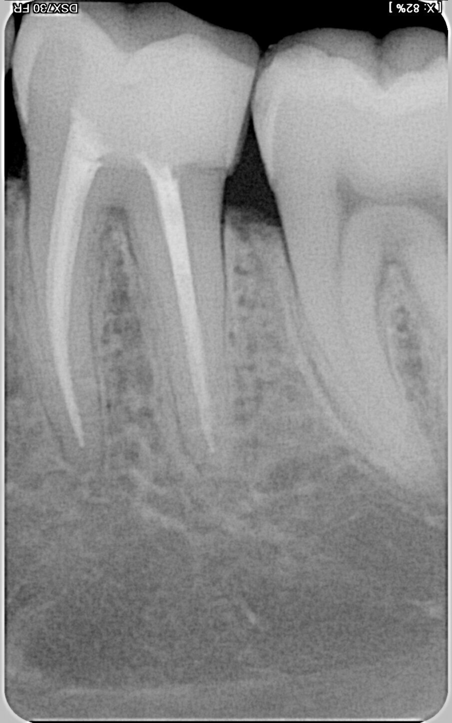 Fig. 4: Pre-op radiographic image of tooth #36 (Case 2). (Image: © Dr Silviu Bondari)