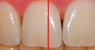 Valutazione clinica dell’azione sbiancante di un dentifricio a base di biossido di titanio con attivazione a luce led