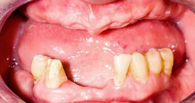 Загубата на зъби се свързва с по-ниска познавателна функция