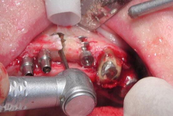 Fig. 8b : L’ostéotomie préalable à l’insertion de l’implant se réalisant le plus souvent latéralement