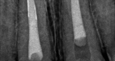 Irrigating the root canal: A case report
