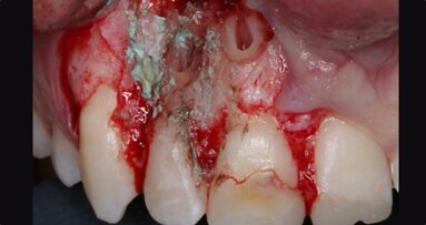 Bone block graft to treat an apicomarginal defect simultaneously with apical surgery of the maxillary incisors: A case report with three-year follow-up