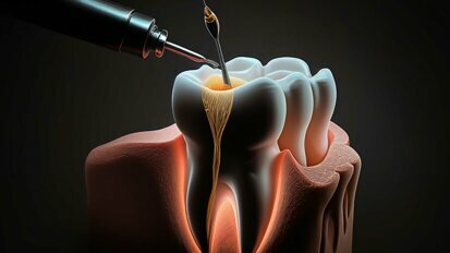 Revolutionäre Endodontie: Die Macht der Digital Geführten Therapie