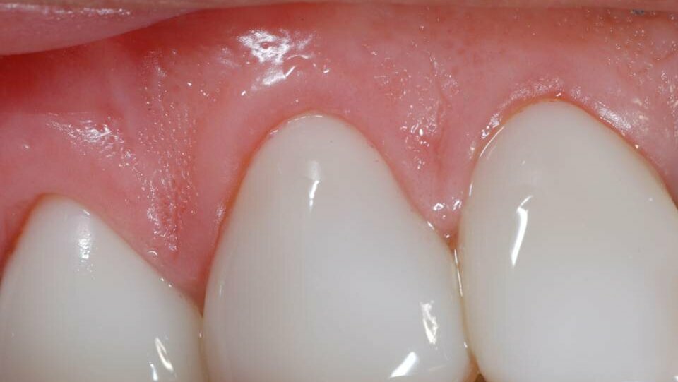 Licówki porcelanowe GlamSmile na zęby dolne i górne  Technika zakładania licówek – Część 2