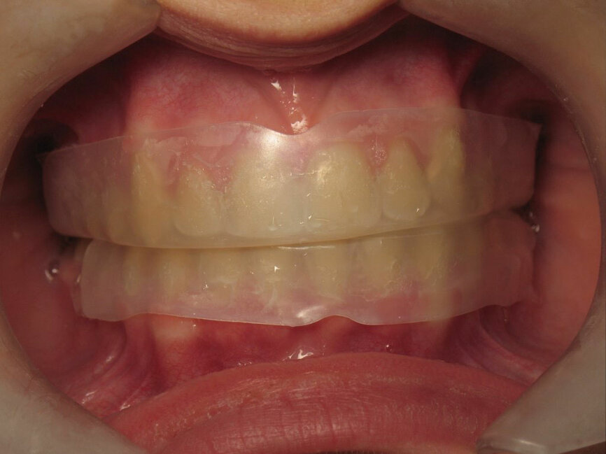 Figura 11. Cubetas precargadas en los dientes.