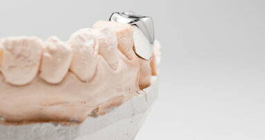 Study proves effectiveness of stainless-steel crowns in restoring permanent teeth