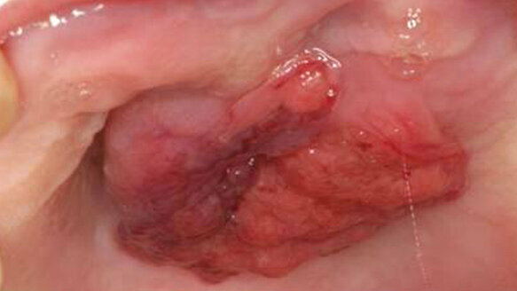 Papillary squamous cell carcinoma of the hard palate: Report of a rare case affecting the oral cavity