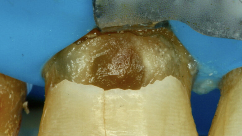 Figura 6. Remoción del esmalte sin soporte dentinario.