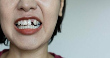 Слабият гликемичен контрол води до загуба на зъби при хора на средна възраст