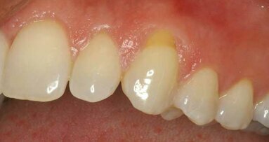 Barriers of success: Cosmetic periodontal surgery (Part 4B)