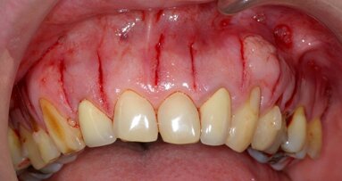 Corticotomies alvéolaires par Lasercision : Une procédure minimalement invasive dans le but d’accélérer les traitements orthodontiques chez l’adulte