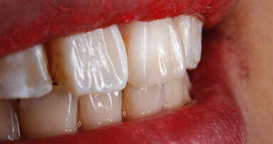 Composite artistry in everyday clinical practice… with BioSmart restoratives