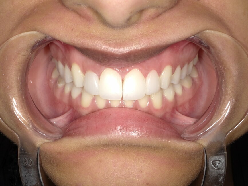 Fig 14: Natural aesthetics achieved with direct veneers 