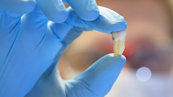 Dentista remove muitos dentes: ação judicial para compensação