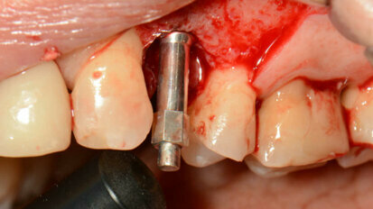 „Neprodáváme implantáty“ – rozvaha nad okamžitým zatížením dentálních implantátů