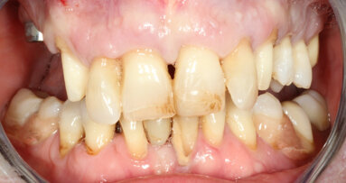 Partial extraction therapy and implant treatment in the maxilla