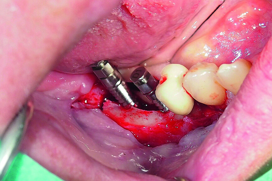 Fig. 17: Creation of space in between the buccal and lingual lamina with the intact attached periosteum on the buccal.