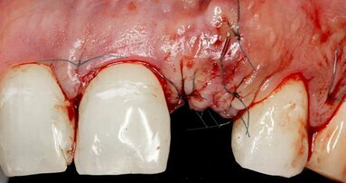 U pacjentów z alergią na penicylinę może wystąpić wyższe ryzyko uszkodzenia implantów zębowych