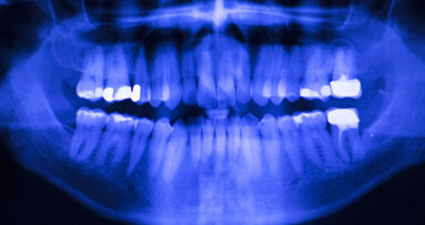 アマルガムからの脱却：歯科医師が適切な修復材料を選ぶための新しいオンラインツール