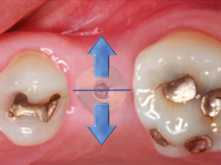 Fig. 5: When minimal keratinized gingiva is present, the diode laser is utilized to make an incision distal-mesially, and the tissue is spread conserving all of the attached gingiva present. (Photo provided by Dr. Gregori M. Kurtzman)