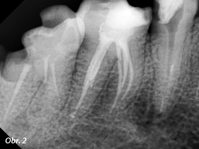 Preoperační rentgenový snímek zubu 46. Obr. 2: Meziálně excentrický rentgenový snímek s pěti viditelnými kořenovými kanálky.